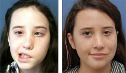 facial paralysis